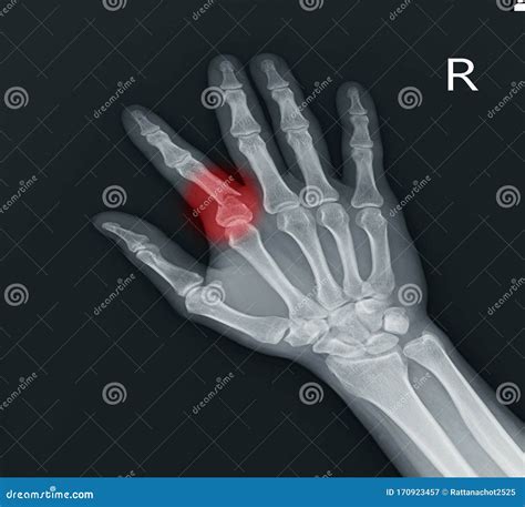 Fracture Index Proximal Phalanx Showing X Ray Hand Stock Image Image