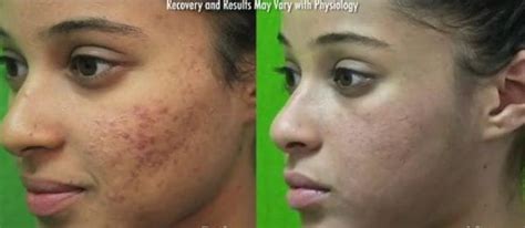 Acne Scar Removal Services Dr U Hair And Skin Clinic Fue Hair Restoration Dermatology And