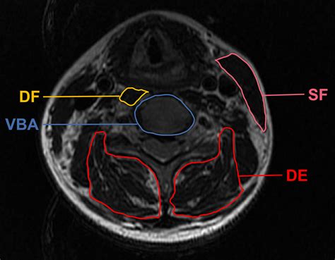 Frontiers The Fatty Infiltration Into Cervical Paraspinal Muscle As A