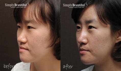 Nose Filler Injection Dr Peter Kim Surgery Skin Cancer Cosmetic