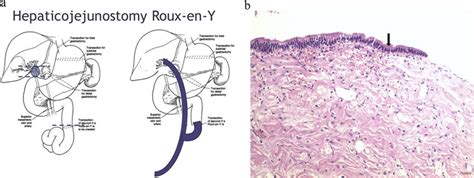 a. Roux-en-Y hepaticojejunostomy. b. Histopathology of right lobe of... | Download Scientific ...