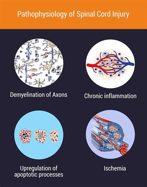 Stem Cell Treatment For Spinal Cord Injury - NeuroGen BSI