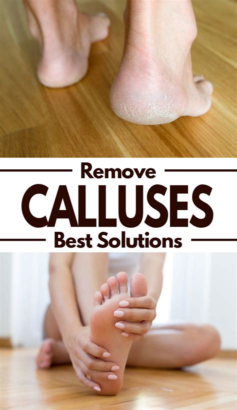 The Best Ways To Get Rid Of Calluses Fluster Buster