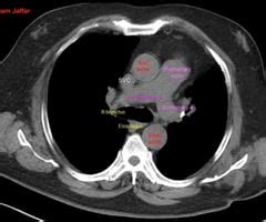 Cross Sectional Ct Anatomy Thorax Flashcards Quizlet