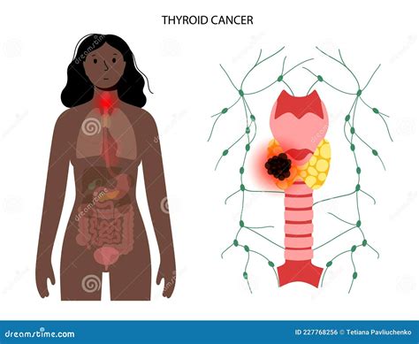 Thyroid cancer stages stock vector. Illustration of woman - 227768256