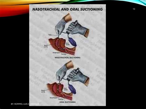 Suctioning Oropharyngeal And Nasopharyngeal Cavities Ppt