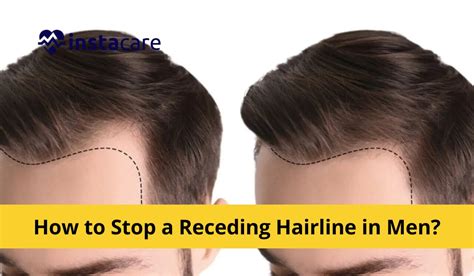 Receding Hairline Signs