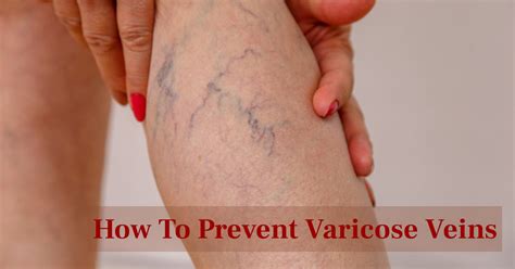 How To Prevent Varicose Veins Naturally Nirogam