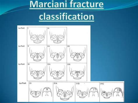 Le Fort Fracture 2 PPT