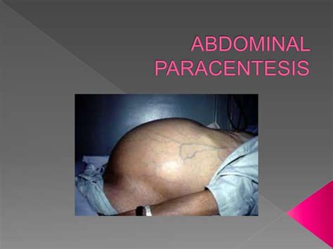 Abdominal paracentesis | PPT