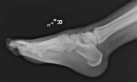 Case Study Of Idiopathic Degeneration Of The Talonavicular Joint The