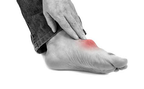 Top triggers for gout foot pain » DiscoverBytes.com