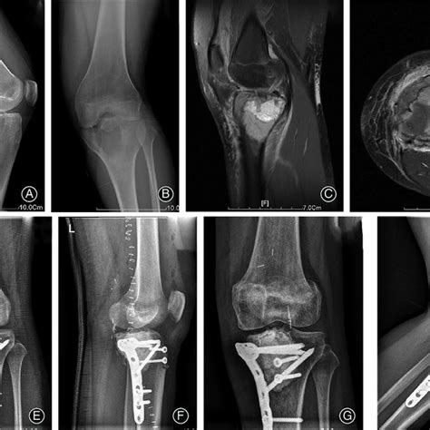 An Illustrative Case Of Giant Cell Tumor Of The Bone GCTB With