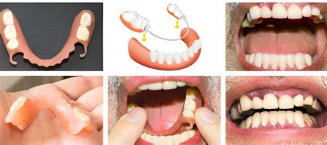 Transformative Smiles Before And After Partial Dentures Guide