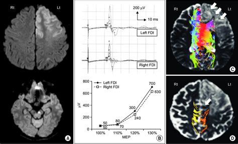 A Diffusion Weighted Image Of Patient Magnetic Resonance Imaging