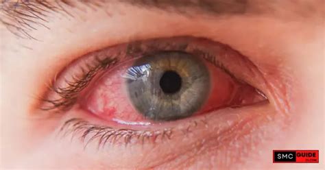 Conjunctivitis Or Pink Eye Proven Early Symptoms Types Treatment