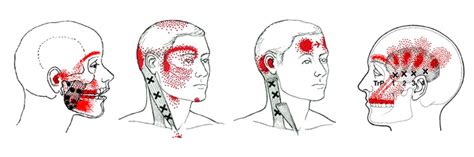 Dry Needling for Tension Headaches — Restore Physical Therapy