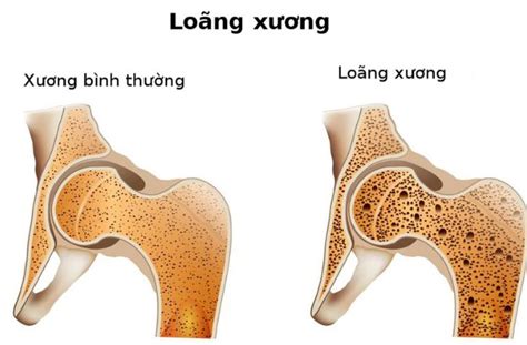 Viêm khớp dạng thấp là gì? Nguyên nhân, triệu chứng và cách điều trị
