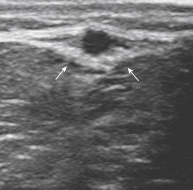 Lower-Extremity Veins - Clinical Tree