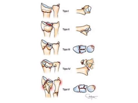 Clasificacion De Fernandez Para Fracturas Distales De Radio Ppt