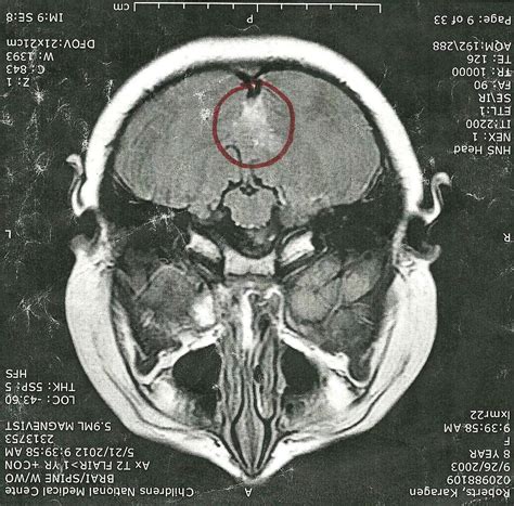 Loves Unfolding Journey Brain Tumor Scans