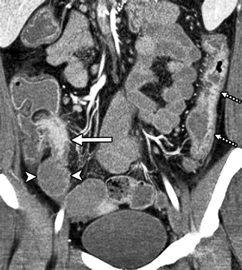 Crohn's Disease CT Scan