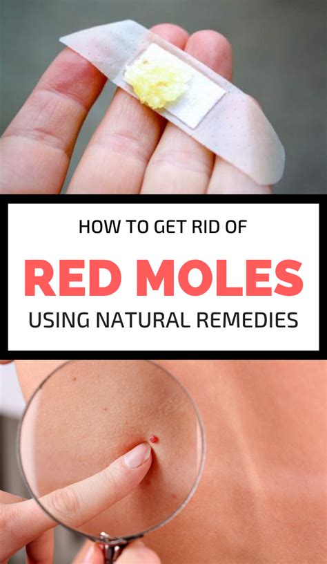 How To Remove Red Moles At Home HOWOTREMO