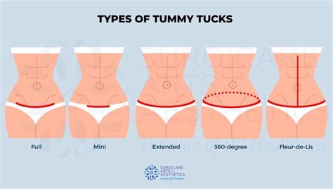 Scar Revision After Tummy Tuck