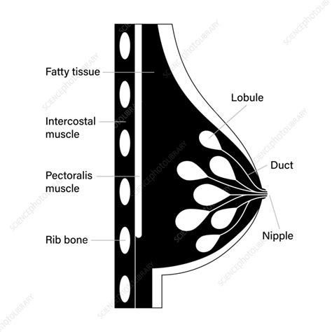 Medical Infographic Cross Section Of Female Breast With Abscess