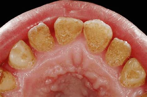 The Palatal Aspect Of The Maxillary Anterior Teeth Presented An