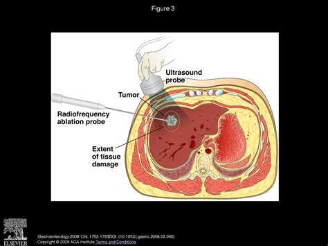 Diagnosis And Treatment Of Hepatocellular Carcinoma Ppt Download