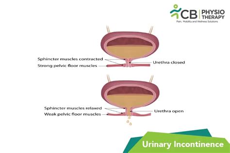 What Is Urinary Incontinence Symptoms Causes Diagnosis