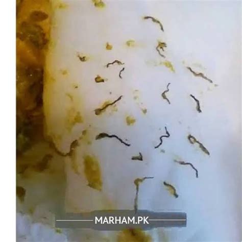 Pinworms In Baby Stool