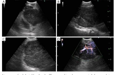 Figure 1 From The Role Of Sonographic Patterns During Endobronchial