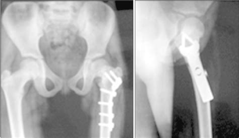 The Postoperative Anteroposterior A And Frog Leg Lateral B