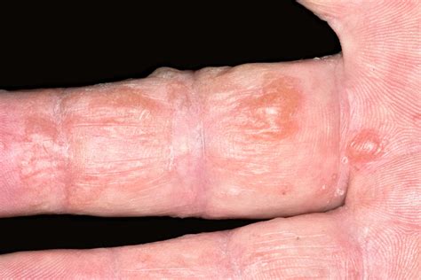 Dyshidrotic Eczema Pictures Symptoms Causes And Treatment