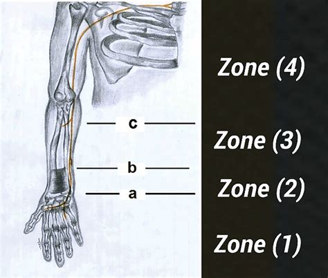 Surgical Zones Of The Ulnar Nerve A The Proximal Border Of Guyons