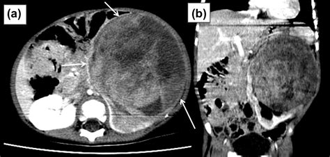 Understanding The Principles In Management Of Wilms Tumour Can