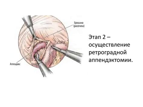 Лапароскопические операции на органах брюшной полости и малого таза ...