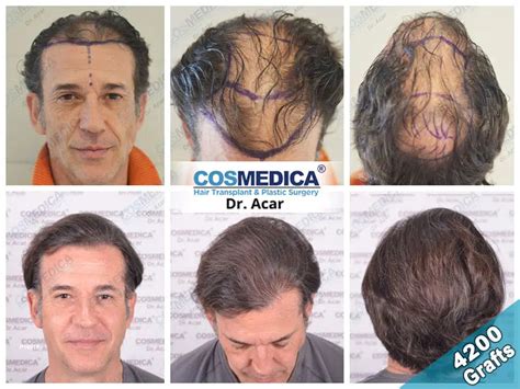 Premium Haartransplantatie In Turkije Istanbul Dr Levent Acar