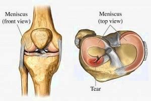 Meniscal Tear-Treatment, Operation, Diagnosis, Causes, Types