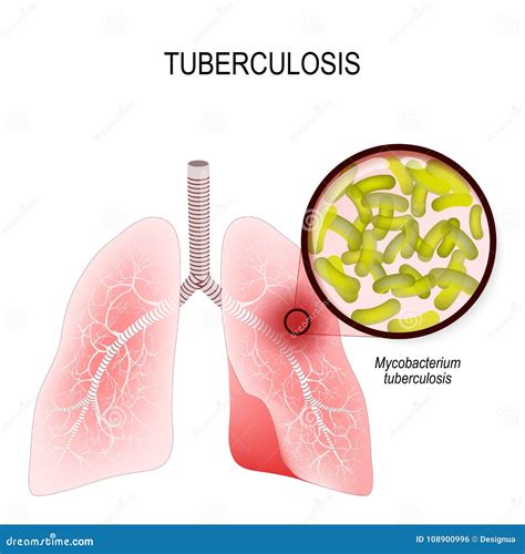 Tuberculosis Is An Infection Caused By Bacteria Lungs Of Infect Stock