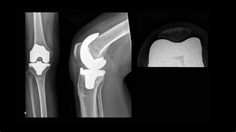 SPECT CT Delineation Of Patellar And Femorotibial Overload After Knee