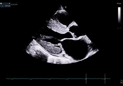 Cardiac Amyloidosis Treatment And Management Point Of Care