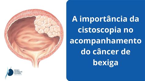 A Import Ncia Da Cistoscopia No Acompanhamento Do C Ncer De Bexiga