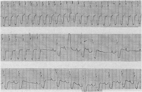 Tracing Of Lead V Showing Supraventricular Tachycardia Terminating Download Scientific Diagram