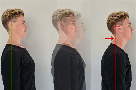 Bad Posture Forward Head