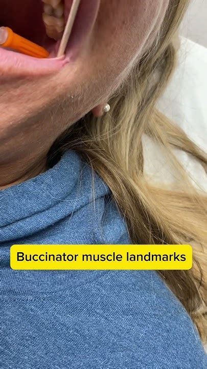 Buccinator Muscle Injection Synkinesis Buccinatormucletreatment Youtube