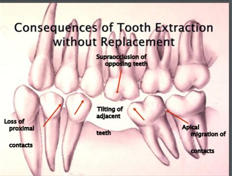 Exam 4 Care Of Dental Prostheses Flashcards Quizlet