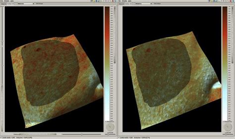 D In Vivo Optical Skin Imaging For Intense Pulsed Light And Fractional